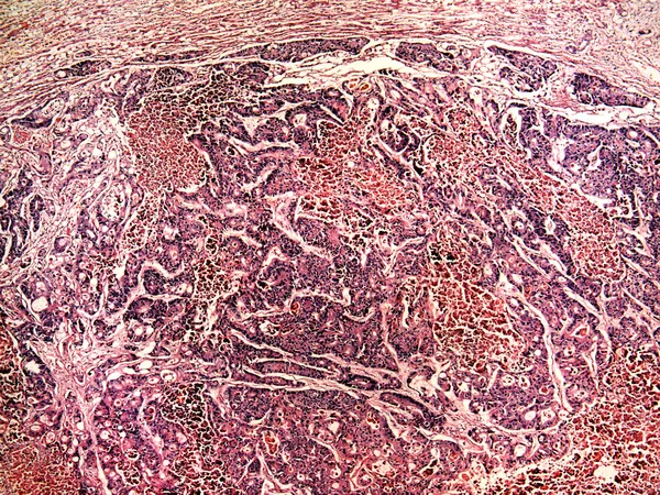 Liver cancer of a human