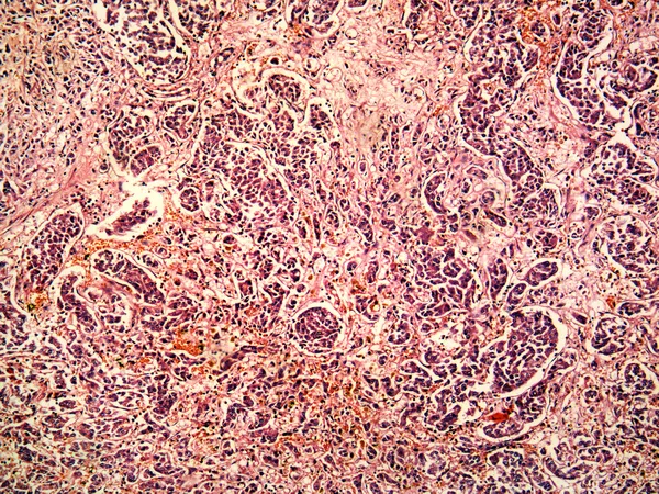 Hepatocellular cancer of liver of a human