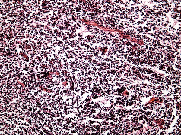 Small-cell lung cancer of a human