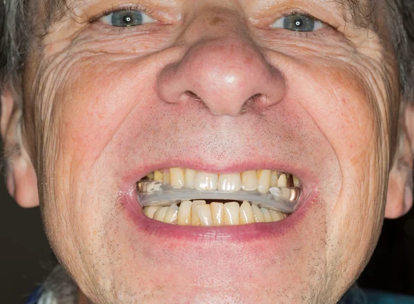 Close up of teeth guard in senior mouth