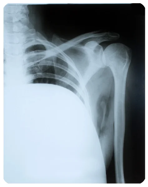 X-ray image of shoulder joint.