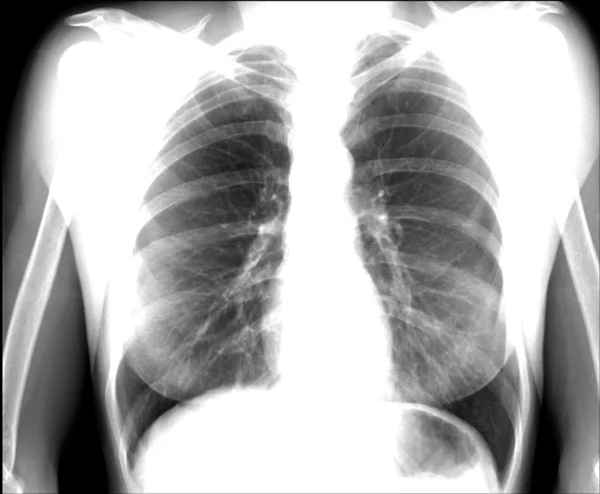 A chest x-ray image