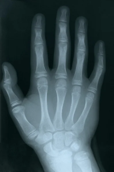 X-ray of a human hand