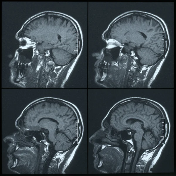 Magnetic resonance image (MRI) of the brain