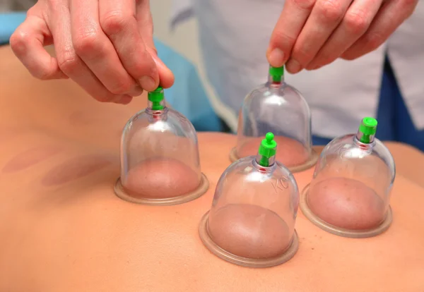 Cupping therapy, woman doctor removes cup from the patient\'s back