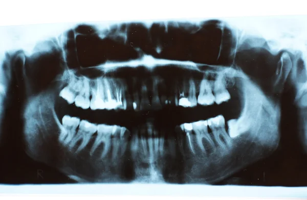 Scanned picture of a X-ray of a human teeth