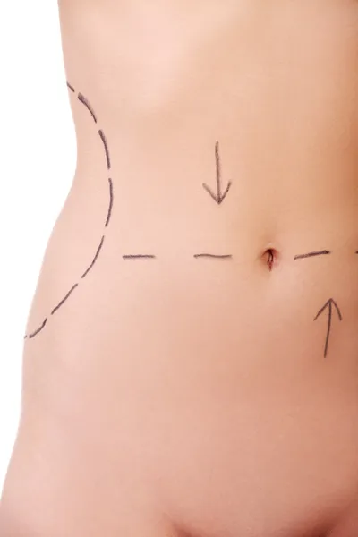 Woman belly marked out for cosmetic surgery