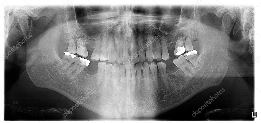 Dental Panoramic X Showing Granuloma Dental Panoramic X Showing Granuloma Stock Photo