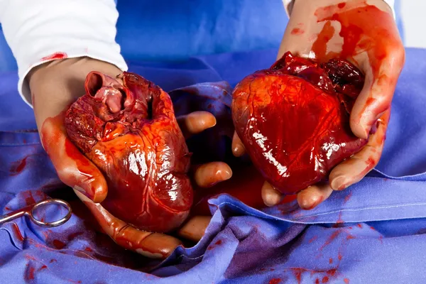Heart transplant operation