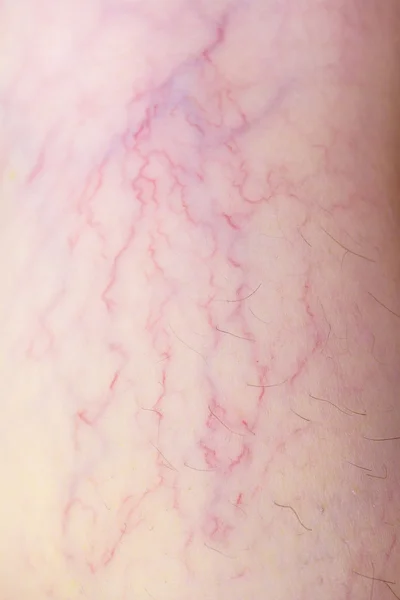 Varicose veins