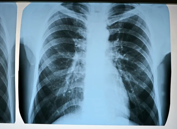 Pneumonia test scanning, modern x-rays radiography