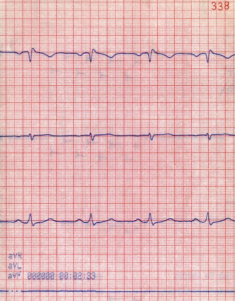 Macro cardio heartbeat diagram, pacient stress concept