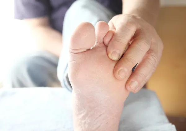 Dry skin on the foot of a man
