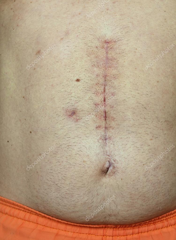 Cicatrice de chirurgie — Photographie kocetoilief © 26668579