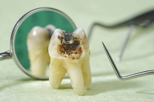 Tooth with dental caries