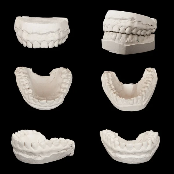 Set of Dental casting gypsum models plaster cast stomatologic hu