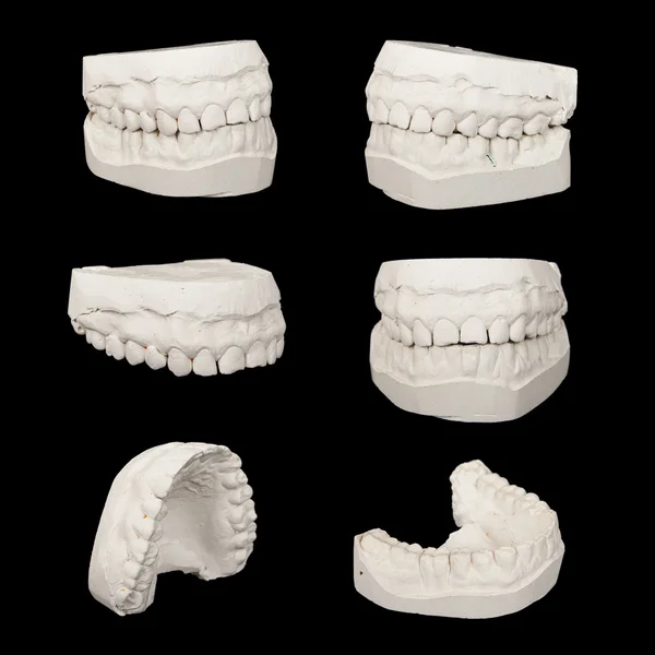 Set of Dental casting gypsum models plaster cast stomatologic hu
