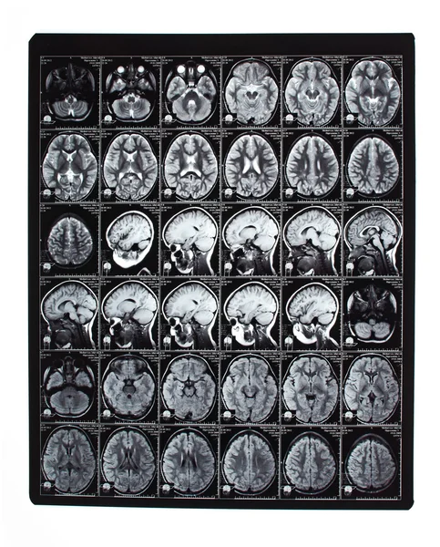 X-ray image of the brain