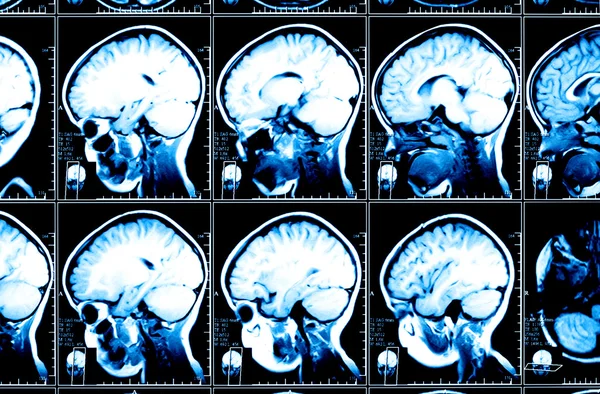 X-ray image of the brain