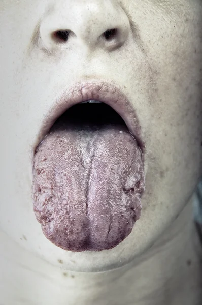 Sick women showing her tongue