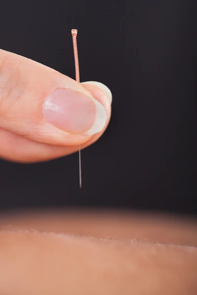 Acupuncture Treatment