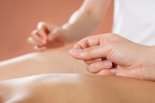 Couple Receiving Acupuncture Treatment At Spa