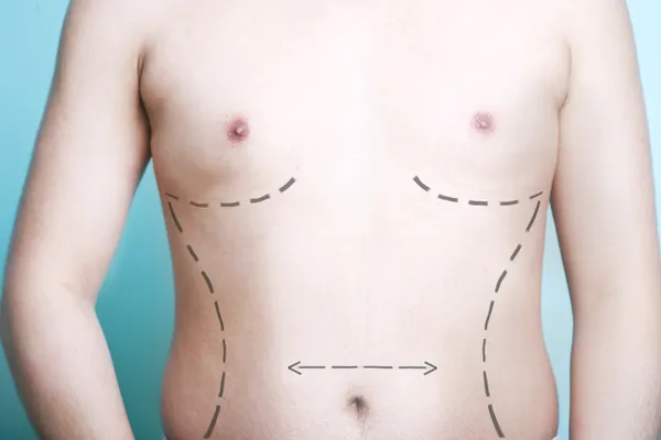 Body with plastic surgery line markings
