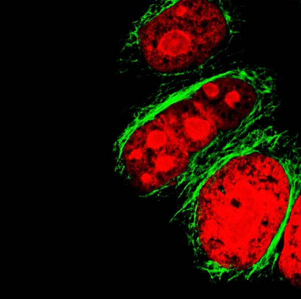 Epithelial tumor cells labeled with fluorescent molecules