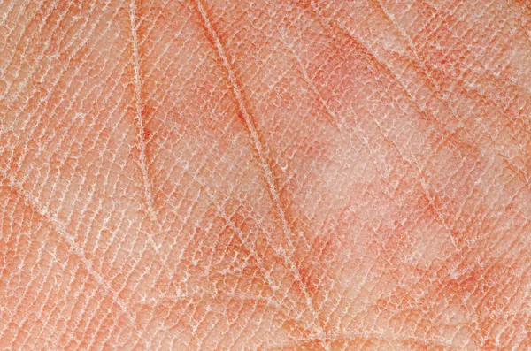 Dry skin texture