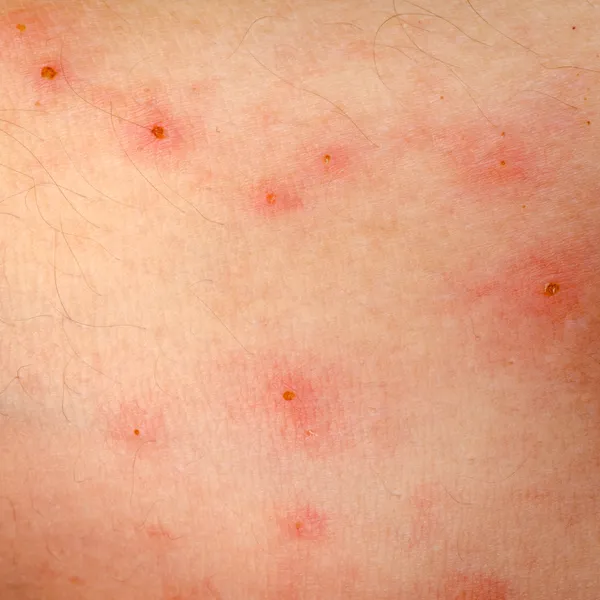 Peau Eczéma Allergique Dermatite éruption Cutanée — Photographie
