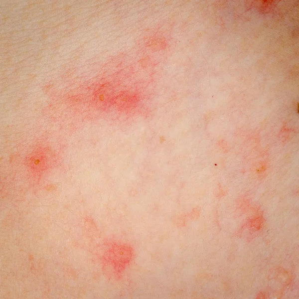 Peau eczéma allergique dermatite éruption cutanée — Photographie panxunbin © 18288827