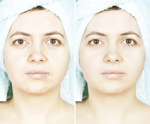 Woman with spotty skin with cicatrices and wrinkles and healed