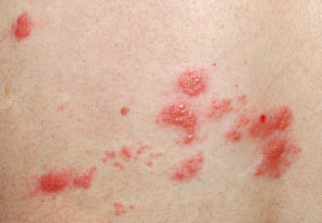 shingles back