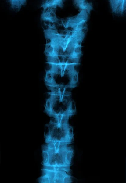 X-ray of human spine bones