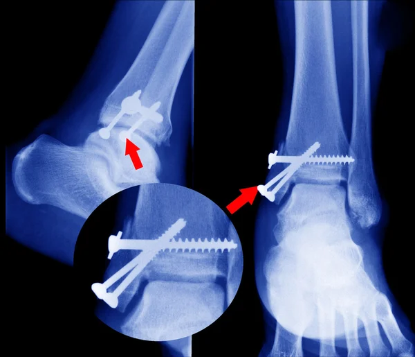 X ray of fractures bone