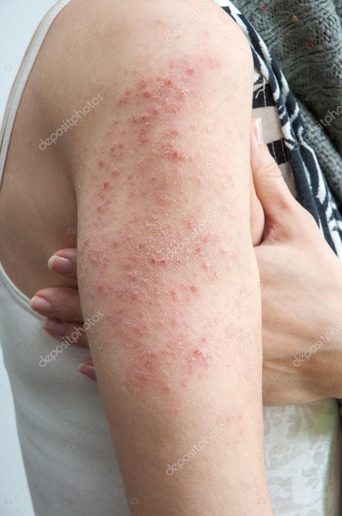How to Identify an HIV Rash: 15 Steps (with Pictures ...