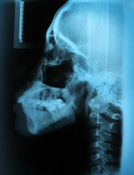X-Ray Skull