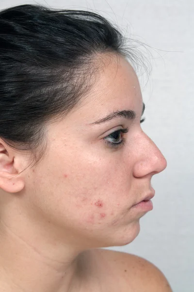 Girl with Acne (3)