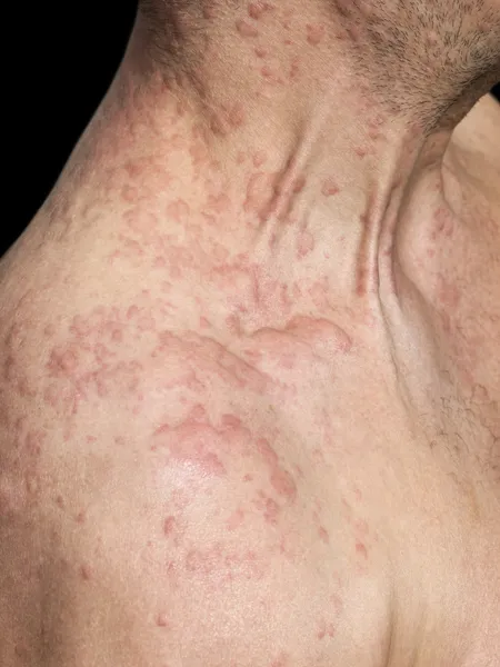 Man\'s shoulder covered with skin allergy
