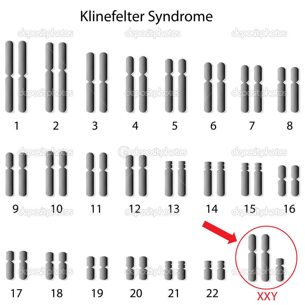 Klinefelter Syndrome Genetic Disorders By Megan Carr