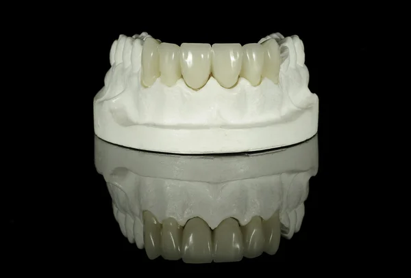 Dental Bridge on a model