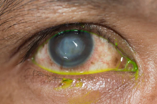 Scar inside eye