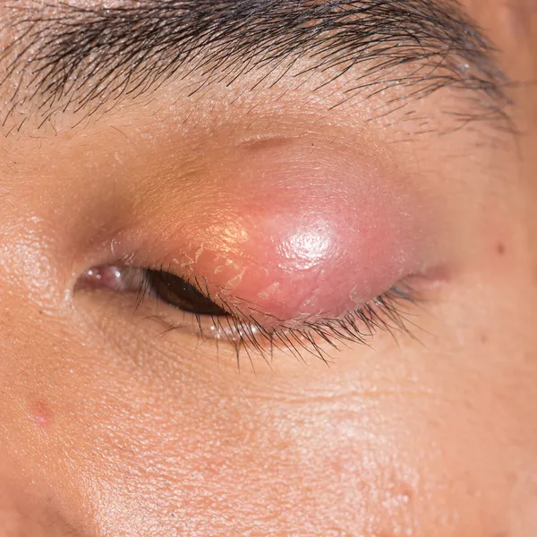 Eye lid abscess 