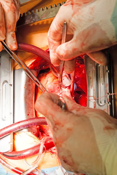 Coronary artery bypass grafting