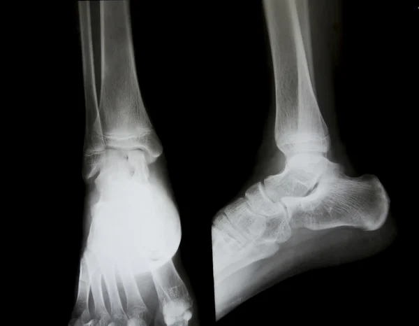 X-ray of both human feet.
