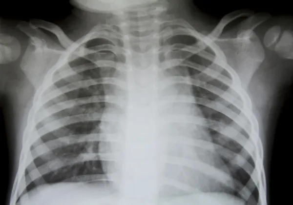 Chest x-ray.