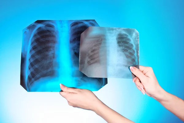 X-Ray Image of two chest on blue background in hand. One man in