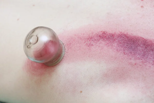 Fire cupping treatment to cup sb therapy woman
