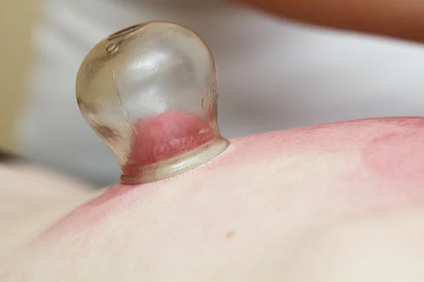 Fire cupping treatment to cup sb therapy woman
