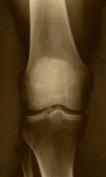 X-Ray of the Knee